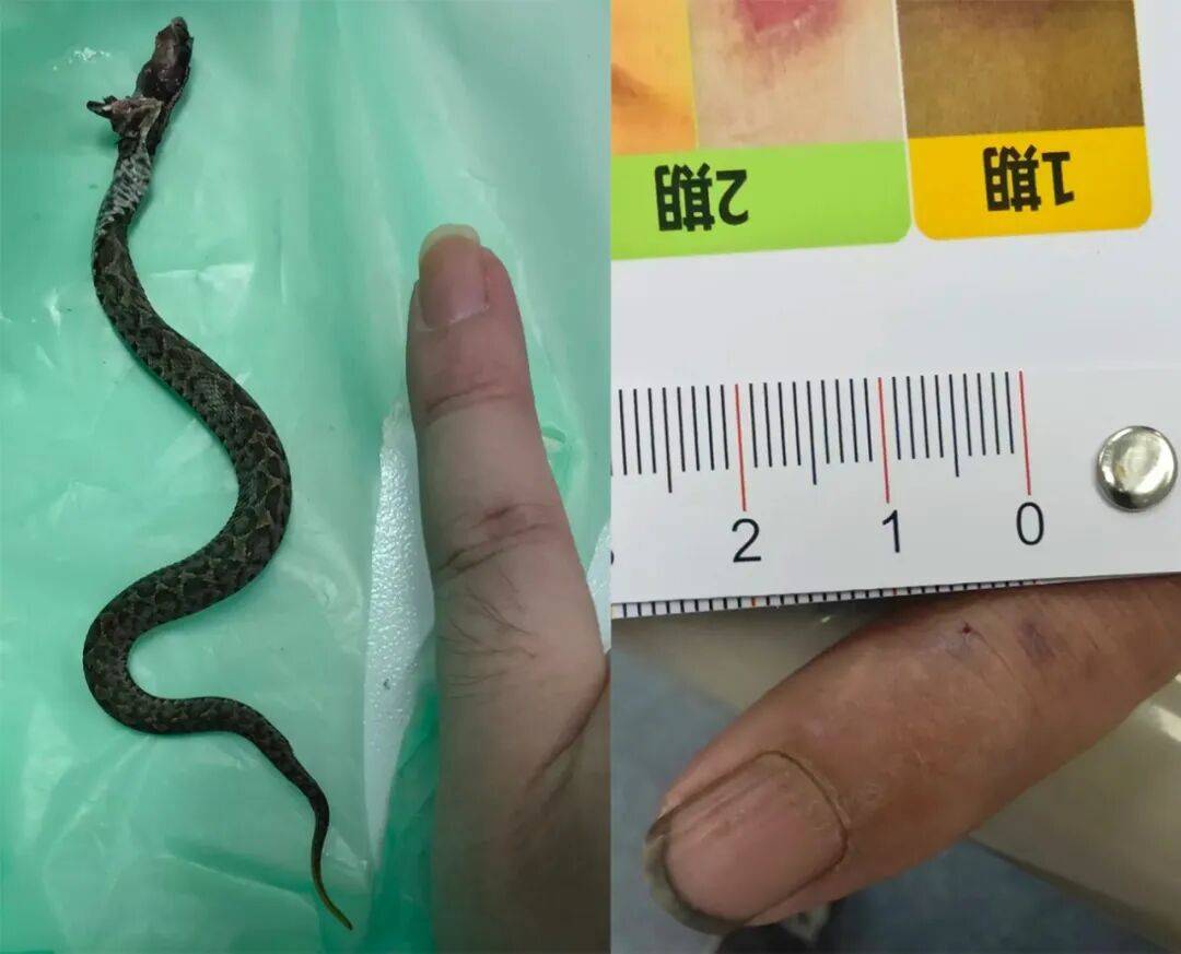 意大利甲组联赛_男子晚上抓黄鳝意大利甲组联赛，摸上来一条毒蛇：狠狠咬住手不放，医生：秋季蛇类活动依旧十分频繁，不要掉以轻心